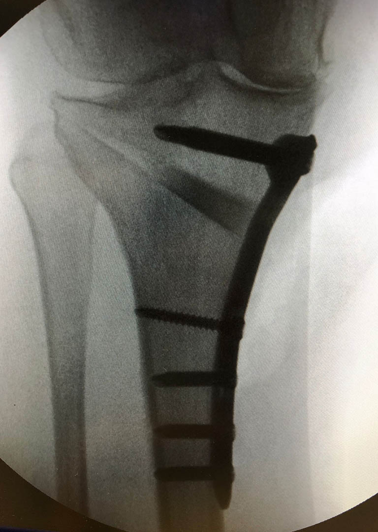 Dr. Soler Traumatólogo Osteotomia Dr. Soler Traumatólogo Osteotomia