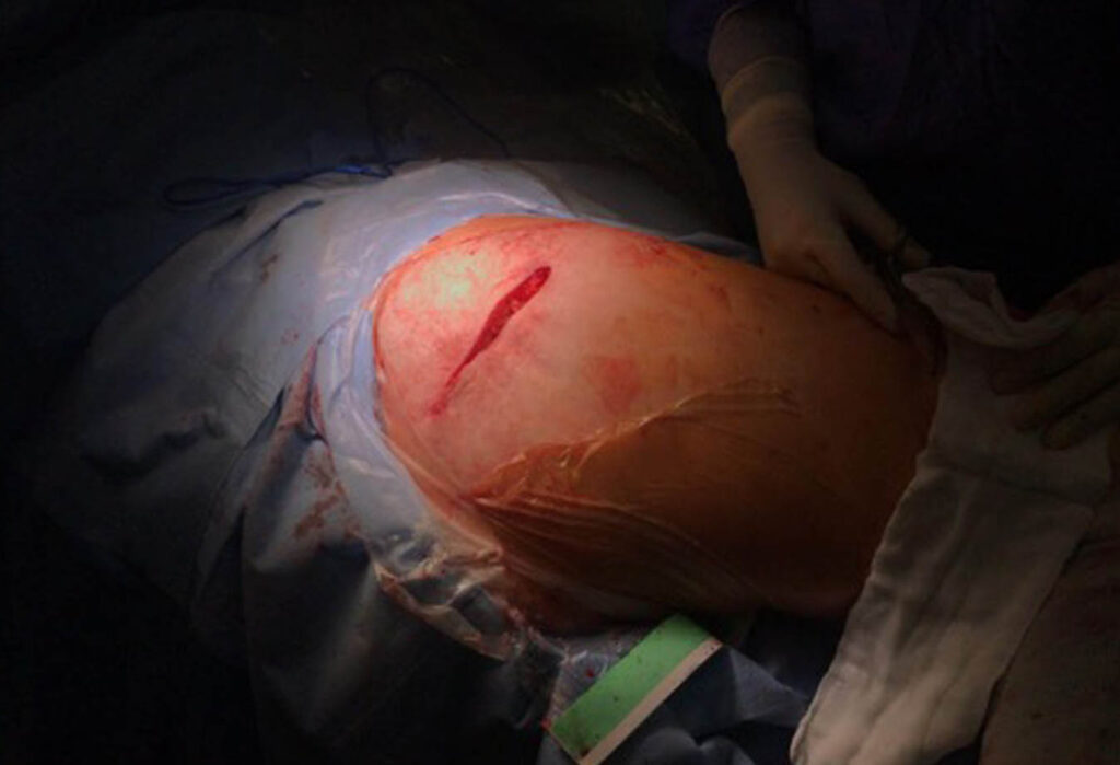 Dr. Soler Traumatólogo Pionero en Cirugía de Cadera Dr. Soler Traumatólogo Pionero en Cirugía de Cadera