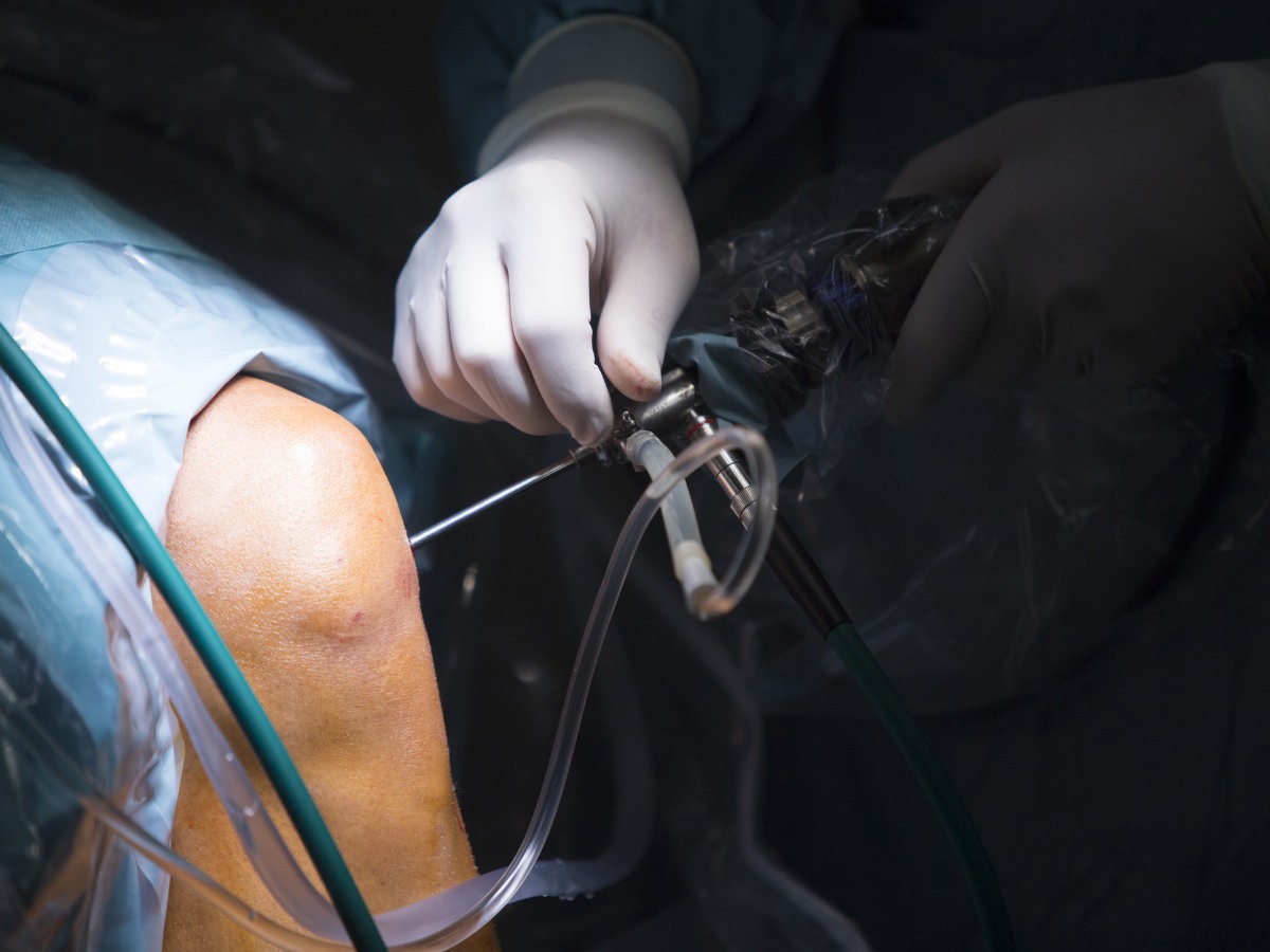 Que es artroscopia de rodilla